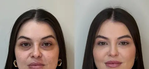 Luana antes e depois da harmonização facial