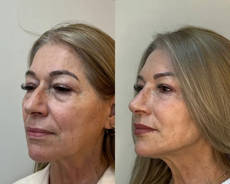 Paciente antes e depois do protocolo Full Face, de três quartos