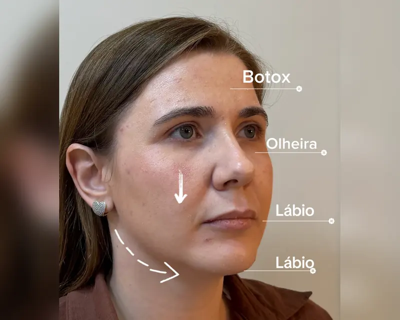 Rosto de uma paciente com o plano marcado: botox, olheira e lábios